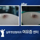 유두축소는 수술 비용이 비슷 비슷 합니다 이미지