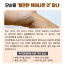 하지정맥류 진단 시 '초음파 검사' 진행하는 이유 이미지