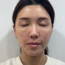 창원피부과 레블라이트 SI 색소레이저 솔직 후기