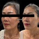 고차원피부관리 | [대구 리프팅] 피부과 온다리프팅 대신 아미뷰티센터 '온써마(티리온X 15만줄 + 써마지 300샷)'로 탄력...
