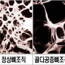 골다공증, 이렇게 모르면 목숨도 위태롭다. 이미지
