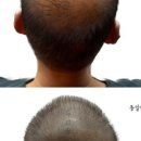 두피움 이미지