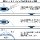 근시에 「眼内렌즈」, 젊은이가 주목 수술의 안전성 높아 이미지