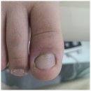 하나메디칼의원 | 의왕역 365늘봄메디칼의원에서 발톱무좀 벗어나기!