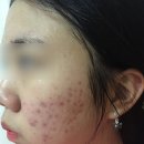 샘물한의원 | 여드름흉터한의원 가격과 효과 후기
