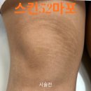 무릎튼살커버 스킨52마포에서 해결하세요