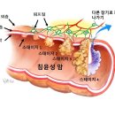 대장암 걸리고 싶나요? 왜 아침까지 독 뿜는 똥을 품고 있나요? 이미지