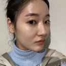 피부과 쥬베룩볼륨엑스퍼트, 더브이티타늄리프팅 키...받은 팔자주름 개선 시술후기, 가격, 결절 부작용