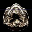 포스유치과의원 | 하악수술 후기 아래턱만 수술하고 싶다면?