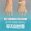 더편한마취통증의학과의원 | 상인역통증의학과 엄지발가락 통증, 무지외반증 단계별 치료 방법은?
