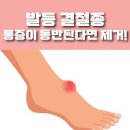 발등통증 원인 결절종 꼭 수술해야하나 이미지