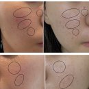 부산여드름흉터한의원에서 새살침 6회차 마지막 후기 <내돈내산>