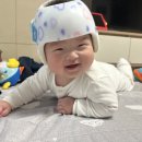 두상 | 6>오쏘코리아 두상교정 헬멧 후기 마지막 이야기 🤍