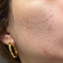 한독큰약국 | 좁쌀여드름 연고 종류별 특징 및 후기