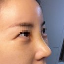 리미트성형외과의원 | 송도 리미트성형외과 자가늑코재수술