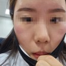 [내돈내산]안성피부관리:믈리에스킨안성점 (진정.트러블.예민피부)