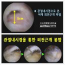 관절내시경 - 어깨회전근개파열 수술 관절경수술잘하는곳 찾기 이미지