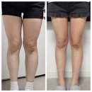 대구 허벅지 지방흡입 2개월차 붓기 엄청 빠진 전후비교 후기 (일상생활, 통증, 멍)