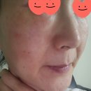 김하경커피 | [청라피부관리] 눈가 가려움 퉁퉁 부은 눈밑, 연고없이 5일 만에 복원한 원장 70% 쌩얼 후기