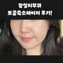 [잠실피부과] 여드름병원추천 모공축소레이저 네오빔 후기