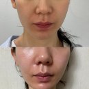 평택간판 | 평택피부과ㅣ평택역 노란간판 피부과 리프팅 텐쎄라 내돈내산 후기, 효과, 통증