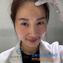 남다른한의원 | 이마 실리프팅 통증 부작용 걱정될 땐 후기 남다른 수아연한의원 미세조정 매선으로(붓기 멍 안보이게 OK)