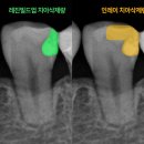 푸른치과기공소 | [청주 인레이] 떨어진 어금니 수복물, 다시 인레이 대신 레진빌드업을 선택한 이유