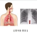 양성 종격동 종양 (Benign mediastinal tumor) 이미지