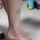 휴엘재활의학과의원 | 여의도 휴엘재활의학과의원 후기 (넘어짐. 발목 인대 파열. 반깁스)