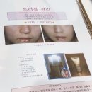 주엽피부관리 에셀스킨케어에서 남자 여드름관리후기