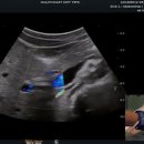 Hot Tips - Locating the Common Bile Duct with Ultrasound 이미지