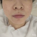 장유피부관리실 장유 보송하이스킨케어 멜라소닉 물방울리프팅 후기