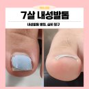 365웰정형외과재활의학과의원 | 7살 내성발톱 교정 목동, 염창동 실비 청구되는 병원 (365웰재활의학과 손발톱 클리닉)