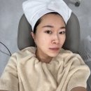 785 | 청담피부과 기미 잡티제거 토닝레이저 색소레이저 헬리오스785후기