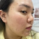 더미스 | 피부관리실 2회차 - 더미스 리페어필 (전후사진, 솔직후기, 내돈내산)