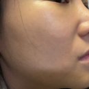 하하한의원 | 압구정역 한의원 얼굴 편평 사마귀제거 하고온 후기