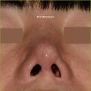 로코코성형외과의원 | 비공내리기, 콧구멍 가리는 가장 강력한 방법은? (3세대 비공내리기)