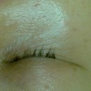 노들담한의원 | 얼굴, 목 편평사마귀 제거비용이 너무 비싸서 이 방법을