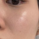 모네맑은의원 | 의정부피부과 여드름 치료 흉터 없애기 / 과진료 절대 안하는<모네맑은의원>