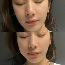 (주)수메디팜 | 창원 상남동 구강외과 오른쪽 상악 하악 사랑니 동시 발치 후기