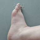 진산부인과 | 임신 부종 붓기 압박스타킹 산부인과처방 후기 산부인과압박스타킹가격