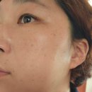 [연산동 피부과] 연산동 메이준 피부과 울트라 듀오 1회차 후기 | 얼굴 홍조, 건조함 개선 기대