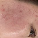 혜리쉬 | 울산 여드름 압출 잘하는 곳 유일한에스테틱 울산점&혜리쉬에서 여드름압출관리 받고왔어요
