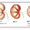 만성신부전증 이미지