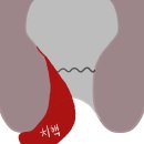 상쾌한 항구병원 | [4월 20일 기록] 포항 상쾌한항구병원 치질수술 다녀오기전 기록