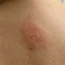 대신금속 | 금속 알레르기 피부 발진, 연고 대신 이뮤라크림으로 진정 관리후기