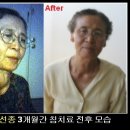 갑상선종(goiter) 돌출부도 없어진다. 이미지