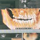 뷰티플란트치과의원 | 부산 뷰티플란트치과 성인 매복 과잉치 발치 후기v^_^v