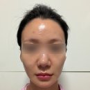 비가랑스킨케어 | 압구정피부과 플래시세렉소 무자극필링 피부관리로 여드름케어 효과 본 후기