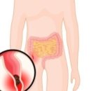 Appendicitis (어펜디사이티즈) 급성 맹장염 이미지